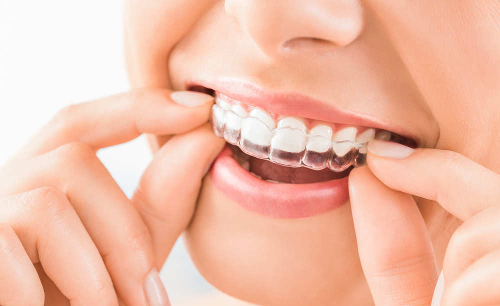 Invisalign Reston Virginia