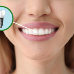 Best Dental Implant Costs in Reston