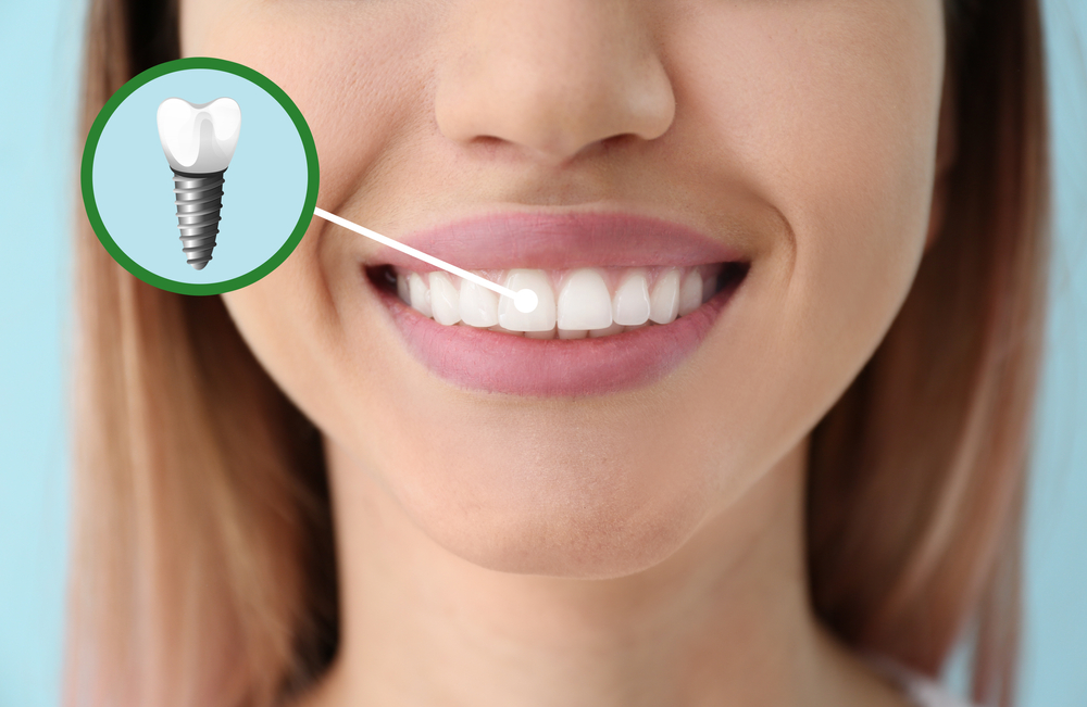 Best Dental Implant Costs in Reston