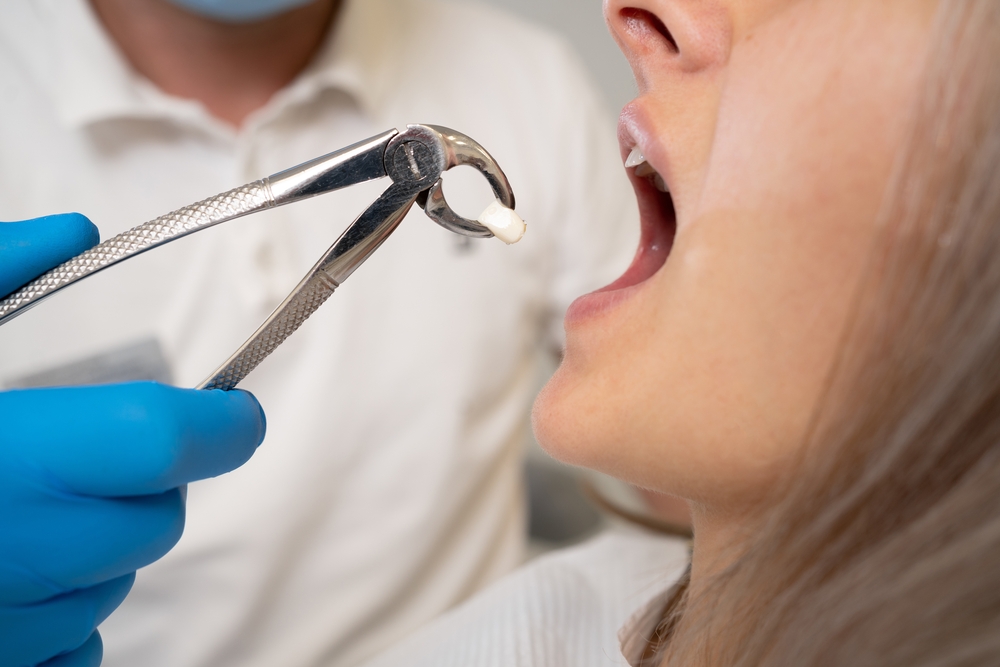 Tooth Extractions