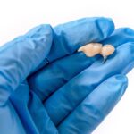 Same-Day Crown Replacement in Ashburn, Virginia: What to Do for a Broken Crown