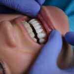 Best Veneer Dentist in Herndon Virginia