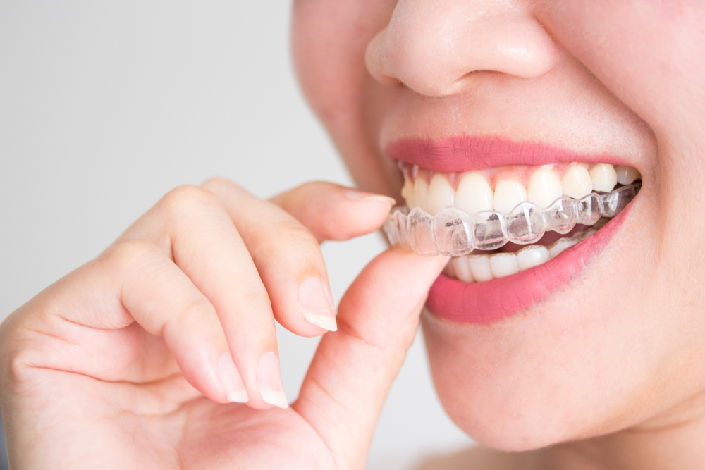 Most Affordable Invisalign in Oakton