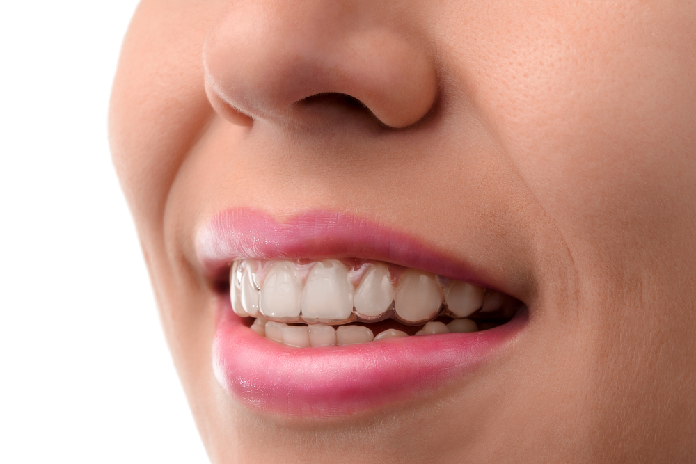 Thanks to the innovative technology of Invisalign, individuals of all ages can enjoy the benefits of clear braces.