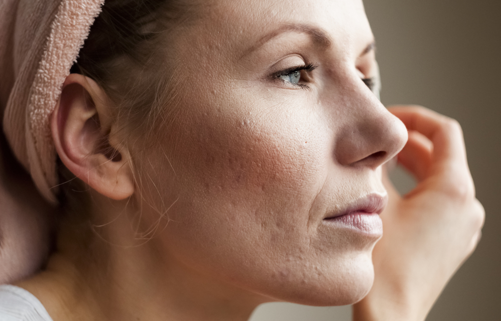 Best Acne Scar Treatment in Reston