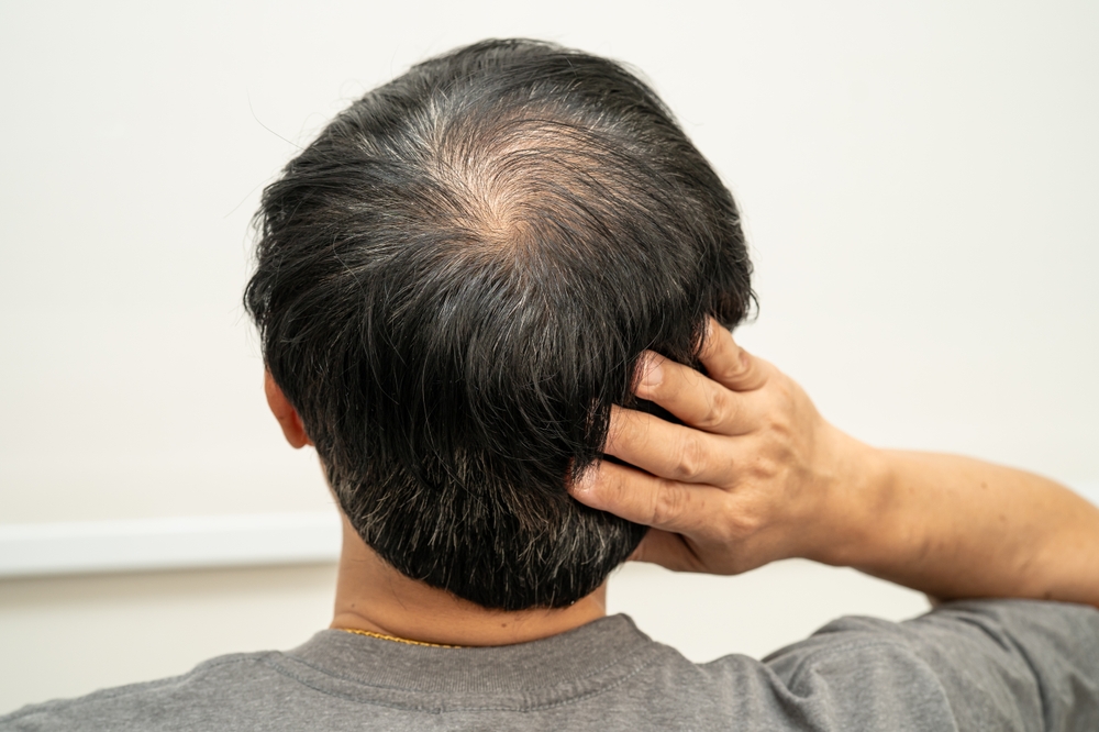 Why Affordable and Free Hair Loss Consultations Near Reston, Virginia Are Worth Your Time