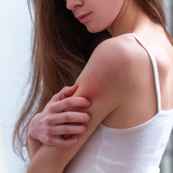 Psoriasis Treatment in Reston VA