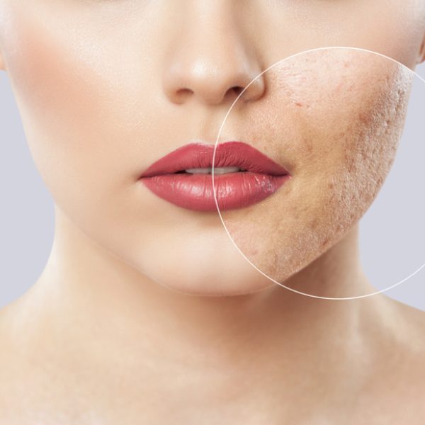 Acne Scars Treatment Reston Virginia