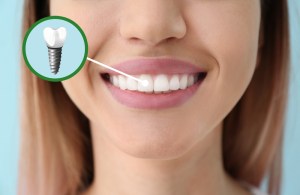 Best Dental Implant Costs in Reston