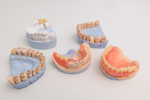 Full-Mouth Restoration Cost in Reston Virginia