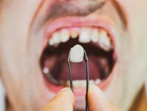 Can a Broken Crown Be Fixed In Herndon Virginia?