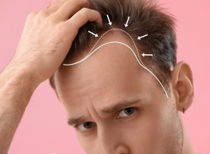Hair Growth Doctor in Reston VA