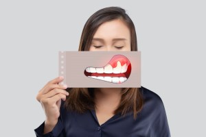 Cracked or Broken Tooth? Here’s What to Do Right Away