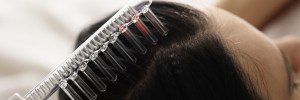 Alma TED Hair Restoration Pricing Near Arlington