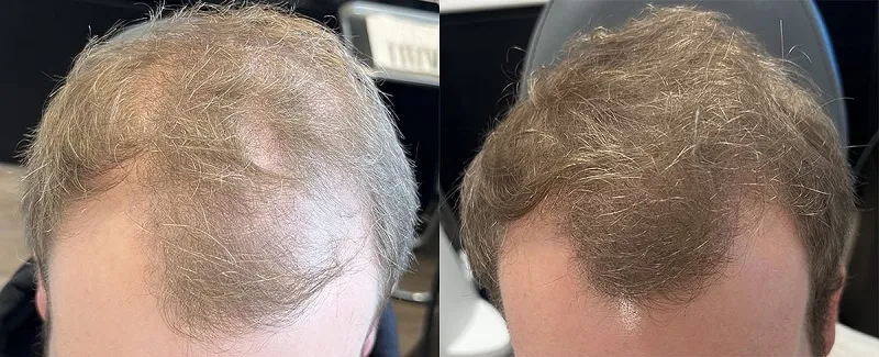 Before and after Alma TED &mdash; enhanced hair volume and coverage at crown area