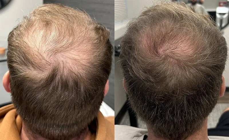Before and after Alma TED &mdash; improved scalp density and natural hair growth pattern