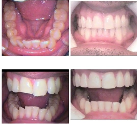 Photo: Before and After 5 Months With Invisalign