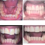 Photo: Before and After 5 Months With Invisalign