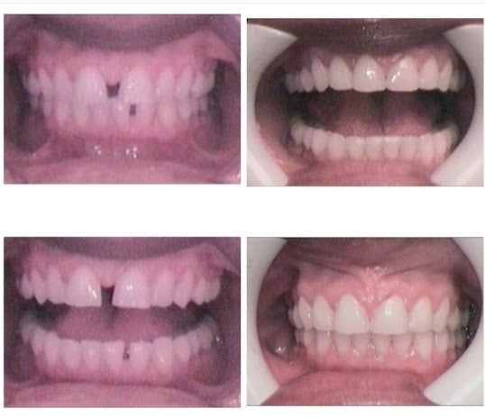 Photo: Before and After Accelerated Invisalign