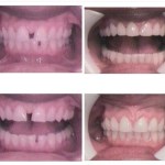 Photo: Before and After Accelerated Invisalign