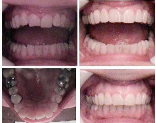 Photo: Before and After Accelerated Invisalign