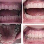 Photo: Before and After Accelerated Invisalign