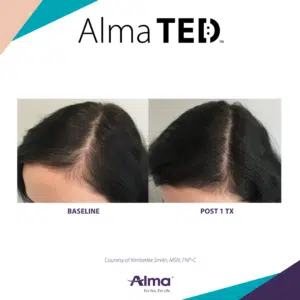Before and after Alma TED hair restoration &mdash; increased density at crown area