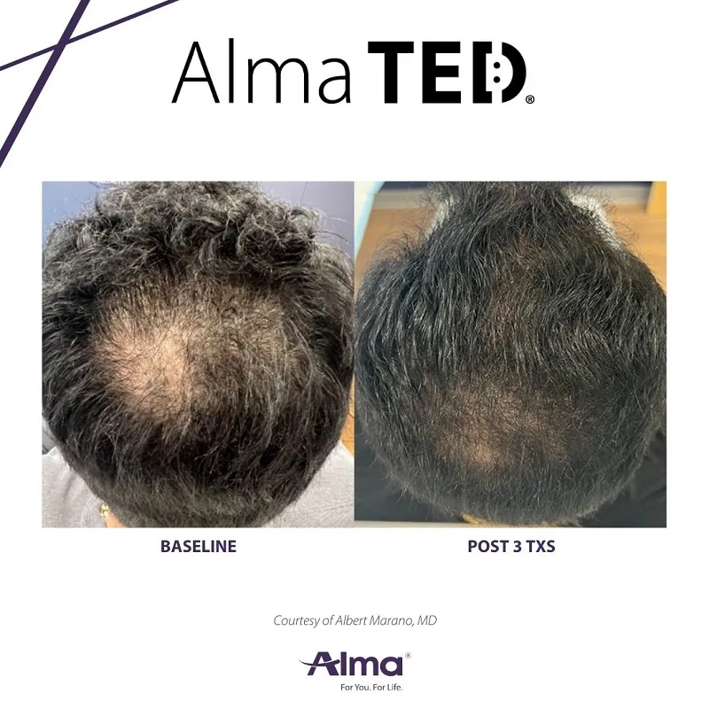Before and after scalp treatment &mdash; increased hair density after 3 Alma TEiD sessions