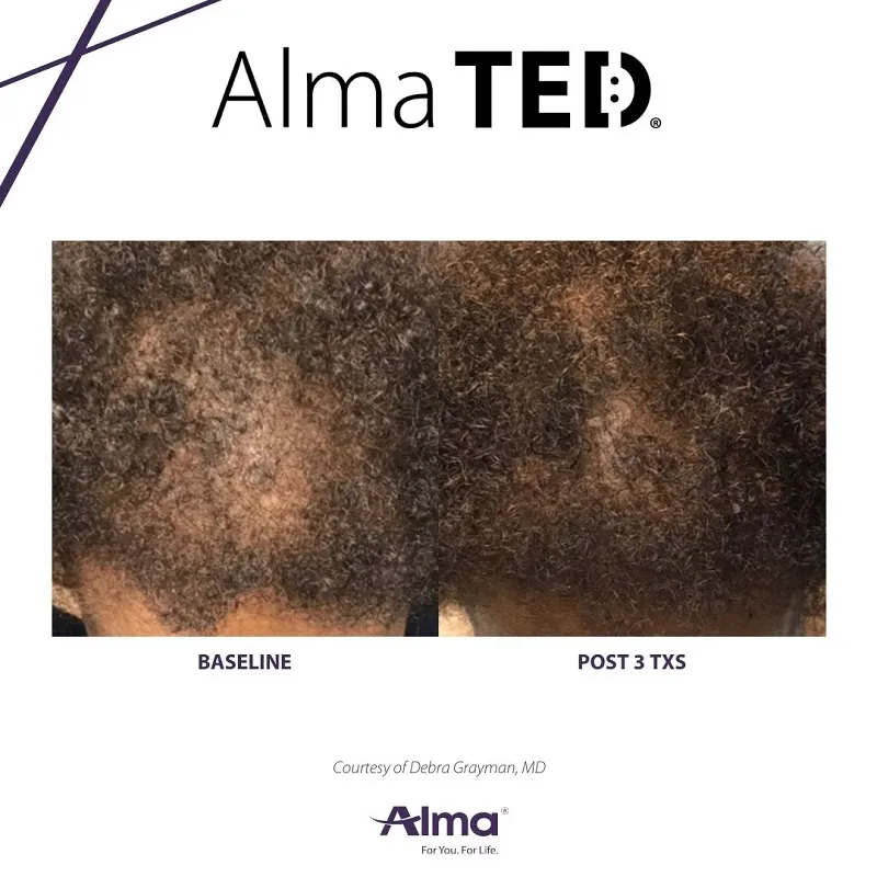 Before and after Alma TED &mdash; significant regrowth in thinning scalp area
