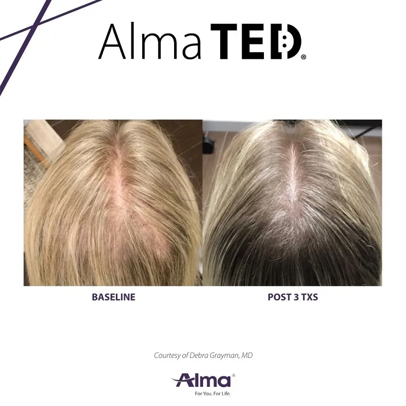 Before and after Alma TED &mdash; improved hairline and scalp coverage in frontal zone