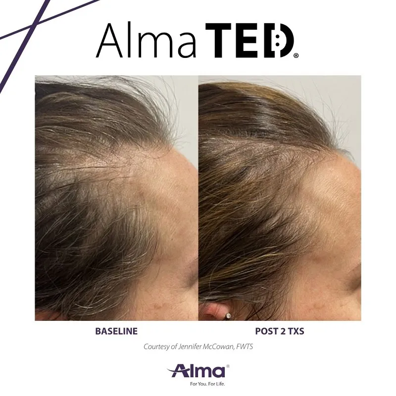 Before and after Alma TED &mdash; thicker, fuller hair texture with natural growth pattern