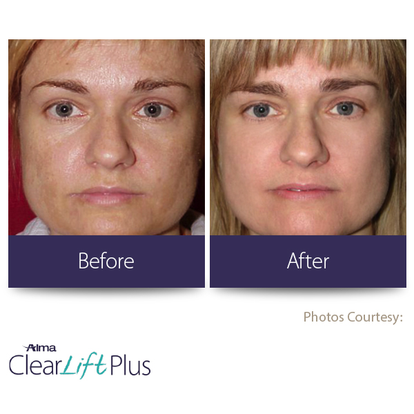 Before and after facial rejuvenation — brighter, more even skin tone with ClearLift Plus
