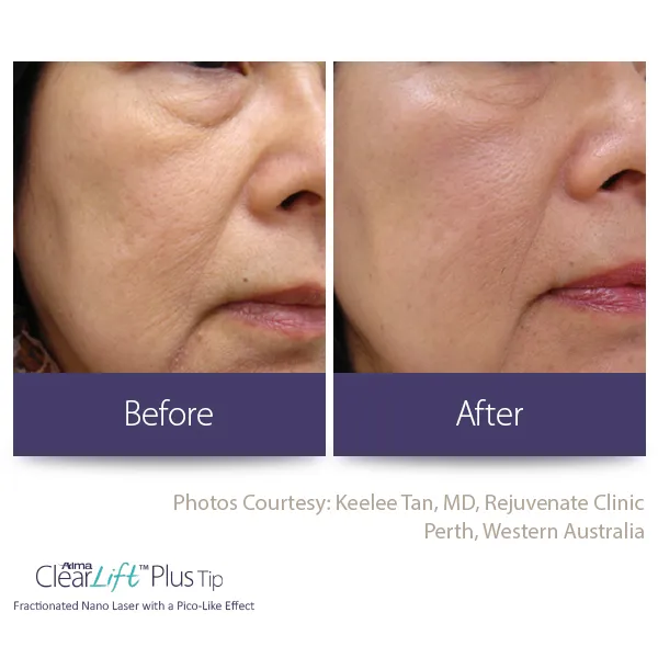 Before and after cheek rejuvenation — smoother texture and tone with ClearLift Plus