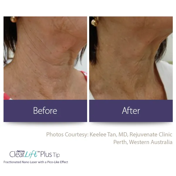 Before and after neck skin tightening — reduced wrinkles with ClearLift Plus (Perth, Australia)