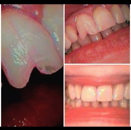 Photo: Before and After Single Visit CEREC Crown to Repair a Fractured Tooth