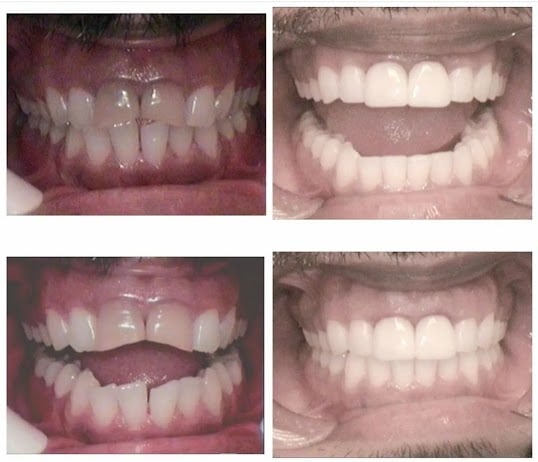 Photo: Before and After Couple Months of Invisalign Followed-by-2-Upper-Front-Single-Visit-Cerec Restorations