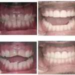 Photo: Before and After Couple Months of Invisalign Followed-by-2-Upper-Front-Single-Visit-Cerec Restorations