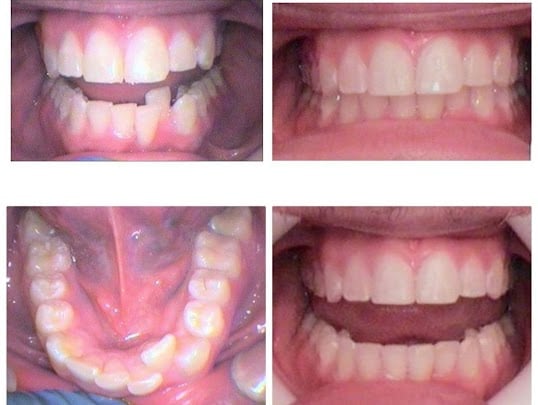 Photo: Before and After Fast Tracked Invisalign