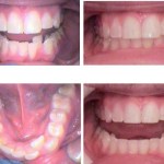 Photo: Before and After Fast Tracked Invisalign