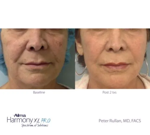 Before and after facial tightening — reduced wrinkles around mouth after 2 treatments