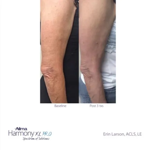 Before and after leg vein reduction — improved tone and texture after 1 session