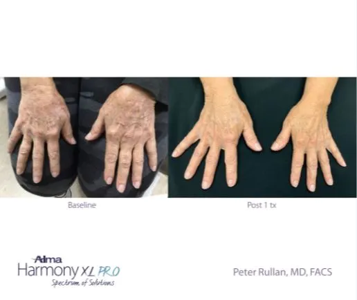 rejuvenation — smoother skin after 1 treatment (Alma Harmony XL PRO)