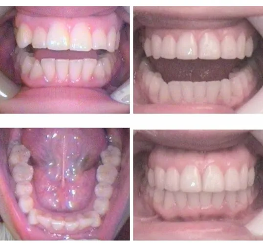 Photo: Before and After Fast Tracked Invisalign