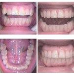 Photo: Before and After Fast Tracked Invisalign