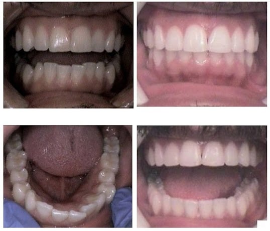 Photo: Before and After Invisalign
