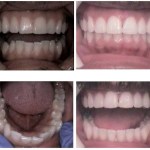 Photo: Before and After Invisalign