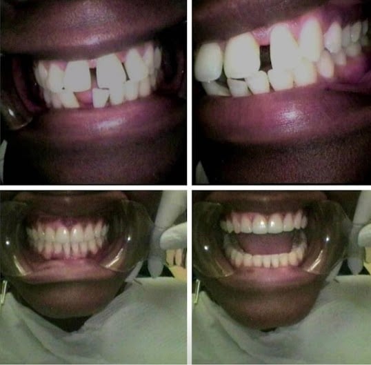 Photo: Before and After Invisalign