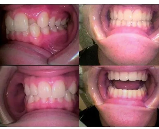 Photo: Before and After CEREC Repair for Fractured Tooth