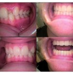 Photo: Before and After CEREC Repair for Fractured Tooth