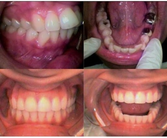 Photo: Before and After Invisalign